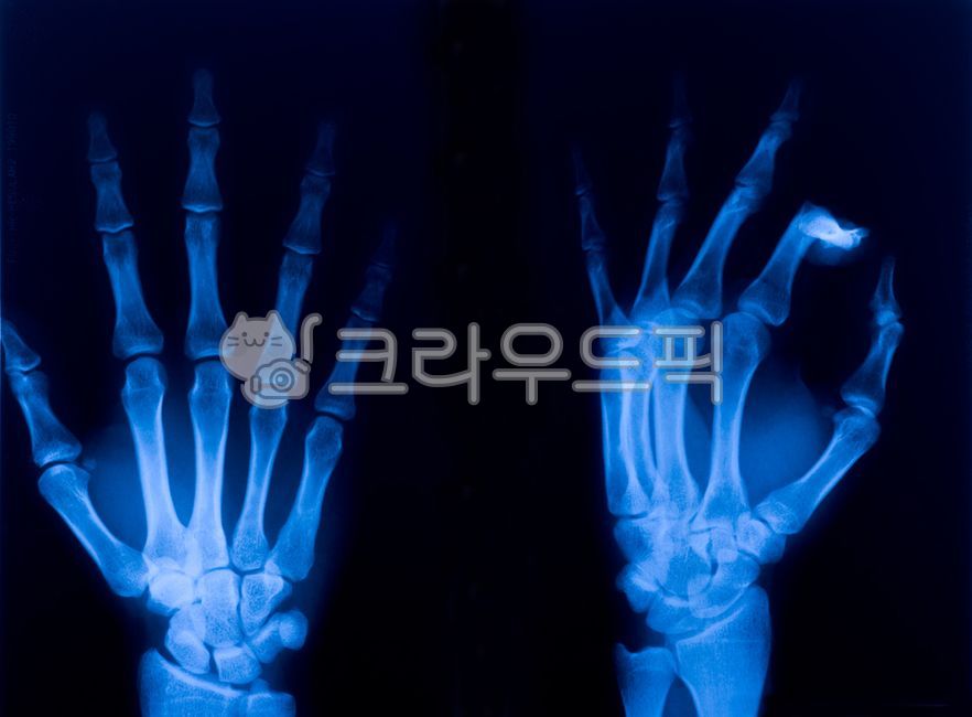 손가락,손목,뼈,엑스레이,정형,외과