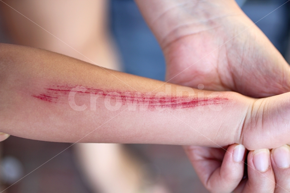 상처,부상,스크래치,팔,연출,사람,다치다,긁힘,Scratch,Wound,피,Blood,Arm,사람,인물,인간,human,person,의료,의학,병원,medical,hospital,clinic,연출,컨셉,콘셉,direction,concept