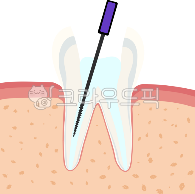 Molar,cavity,root canal,tooth,dentistry,inflammation,crown,inlay,resin,cervical area,abrasion,gums,periodontology