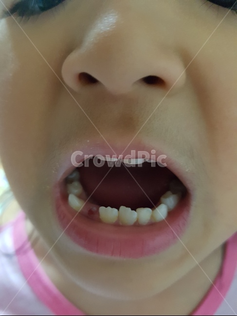 입,이,teeth,mouth,발치,송곳니,유치,치아,치과