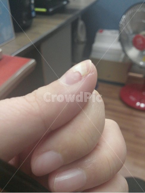 손톱성형,손톱깨짐,손톱,손톱부서짐,손톱재건