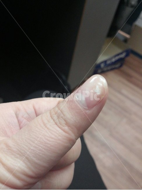 재건메니큐어,손톱재건,손톱성형,손톱깨짐치료,손톱치료