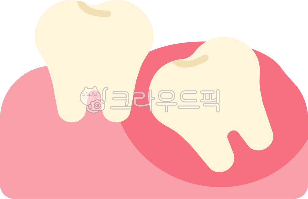 Impacted wisdom tooth,wisdom tooth,wisdom tooth extraction,wisdom tooth extraction,wisdom tooth pain,extraction,wisdom tooth rash,back molar,molar,wisdom tooth removal,dentistry,teeth,teeth,this,wisdomtooth,dental,dentist,tooth,teeth,gu