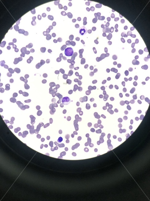 segmentedneutrophil,호중구,분절호중구,미성숙호중구,성숙호중구,diffstain,quickstain,myeloblast,metamyelocyte,골수모세포,골수아세포,후골수구,cbc,혈액검사