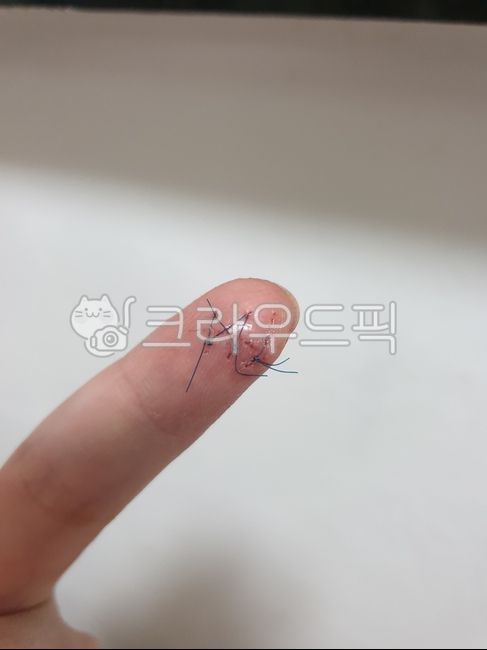 자상,봉합,상처,수술,손가락,응급실