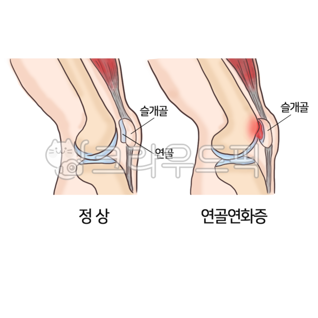 joint,body parts,cartilage,body,cartilage treatment,patella,chondromalacia,knee,knee area,person,Orthopedics,hospital,cartilage shape