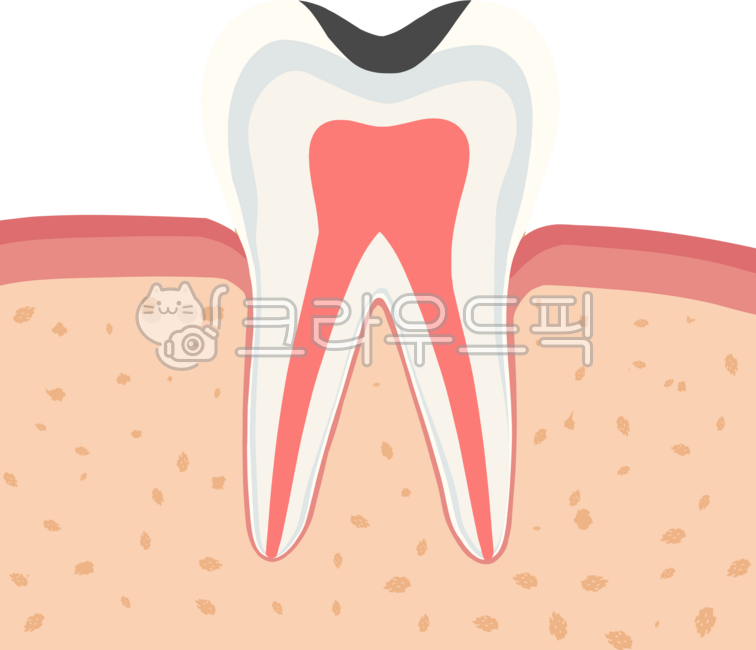 Molar,cavity,root canal,tooth,dentistry,inflammation,crown,inlay,resin,cervical area,abrasion,gums,periodontology